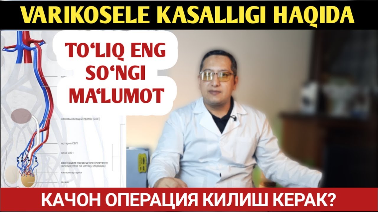 VARIKOSELE KASALLIGI HAQIDA. TO‘LIQ ENG SO‘NGI MA‘LUMOT. HAR DOIM OPERATSIYA QILINMAYDI!!!