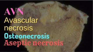 Avascular Necrosis - Pathology mini tutorial