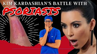 Kim Kardashian's Battle with Psoriasis