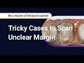 Tricky cases to scan  unclear margin