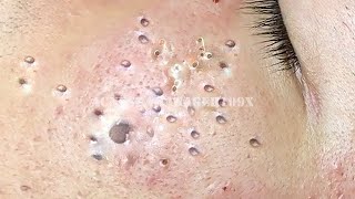 acne blackheads whiteheads removal 8627