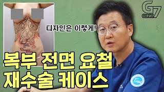 복부지방흡입을 고려하신다면 이 영상을 꼭 미리 보세요 (요철의 부작용을 피할 수 있는 팁을 드립니다)