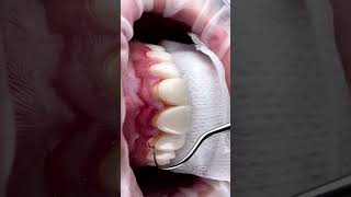 Try in before cementation. Video by Dr Ahmad Bandora @clinicoval
