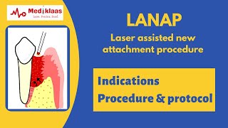 LANAP (Laser assisted New Attachment procedure) l Periodontal Regeneration l Mediklaas by Mediklaas 21,784 views 3 years ago 6 minutes, 49 seconds