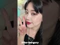 [Plastic Surgery in Korea] More Beautiful After Doing Rhinoplasty at DA! #shorts