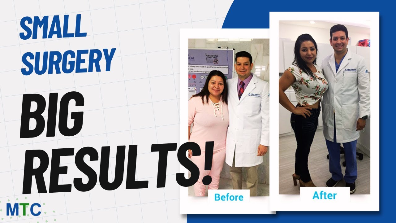 Mini Gastric Bypass in Nuevo Laredo: Why the Rise in Popularity? - YouTube