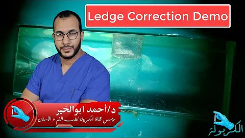 Ledge Correction Demo Mixed Manual and Rotary techniques