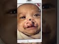 Bilateral wide cleft lip repair done 6 ML the back. The cutie has now come for palate repair