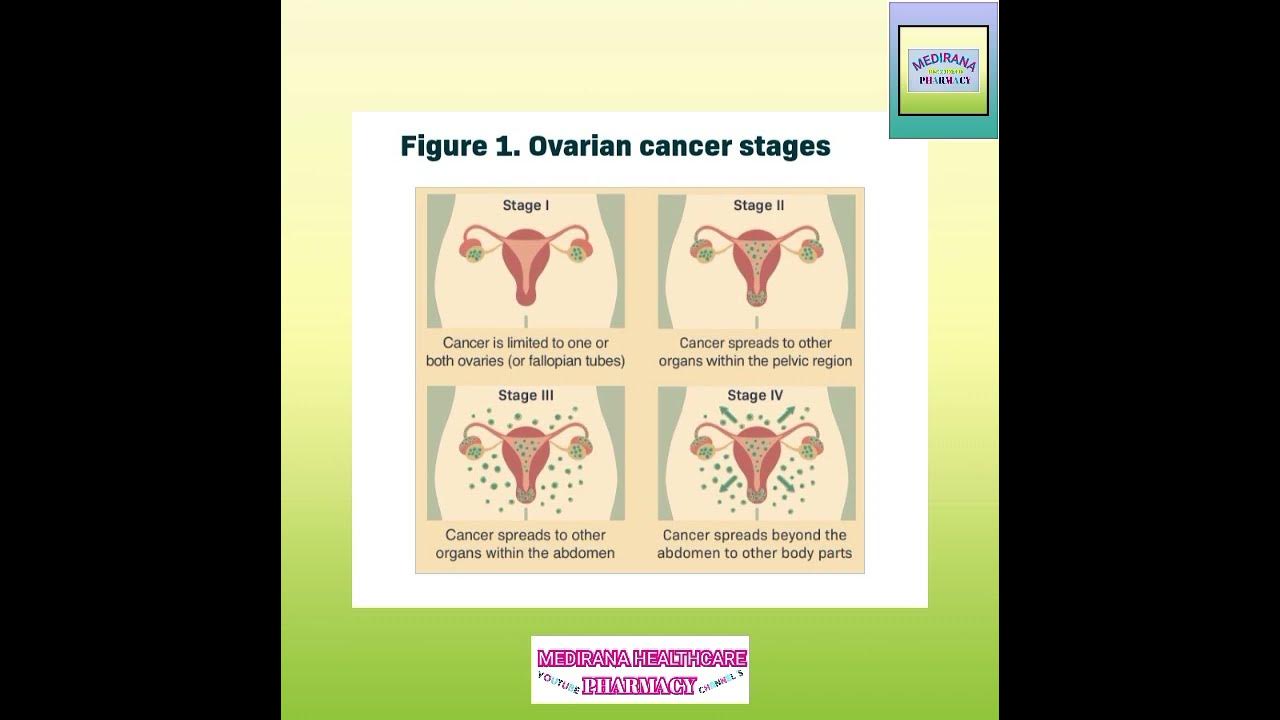 ovarian-cancer-cause-of-ovarian-cancer-stage-of-ovarian-cancer