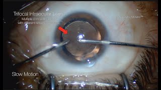 Cataract Surgery Tijuana, Mexico| Trifocal lens | Presbyopia