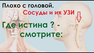 Головокружение, шум и тяжесть в голове: расшифровка УЗИ позвоночных артерий и(или) чем его заменить