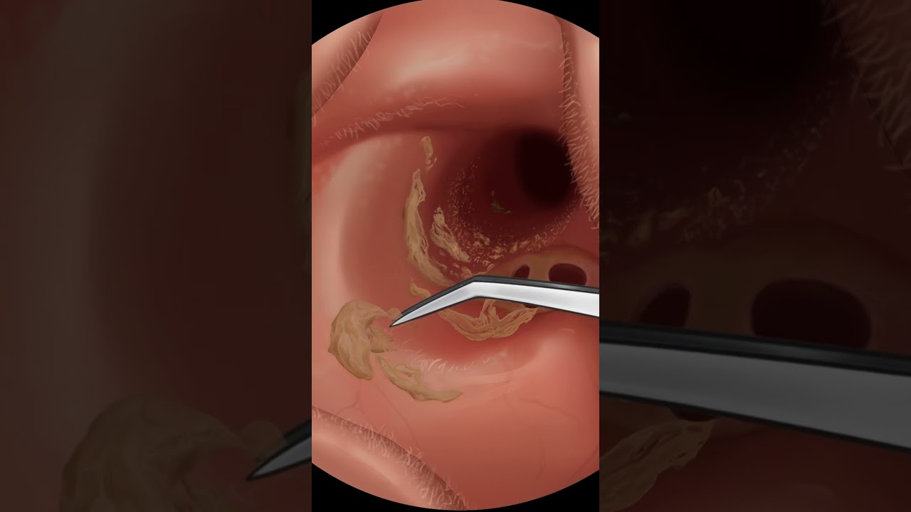 ASMR|ear pimple blackhead care|sebaceous cyst removal #asmr