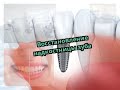 Восстановление надкостницы зуба