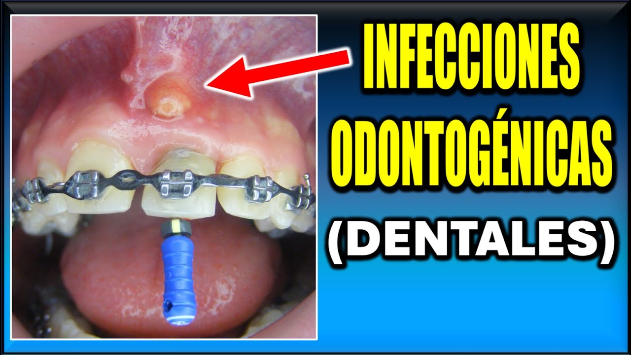 ALERTA Dental ! Lo Que Debes Saber Sobre Infecciones en la Boca - YouTube