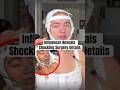 Influencer Reveals Shocking Surgery Details #shorts #liposuction #plasticsurgery