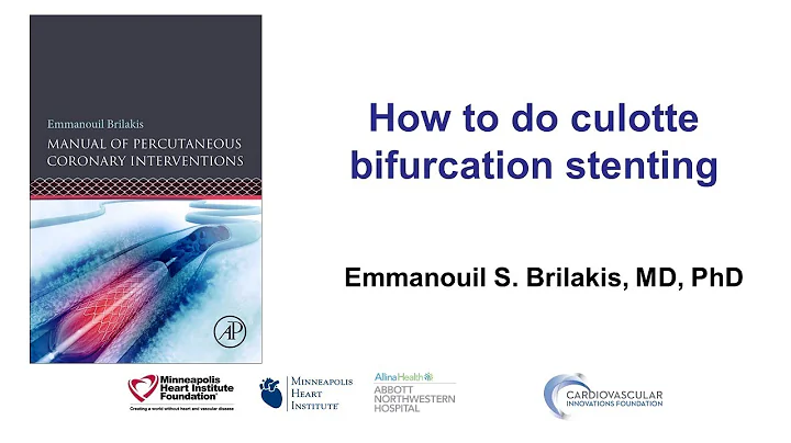 How to do culotte bifurcation stenting