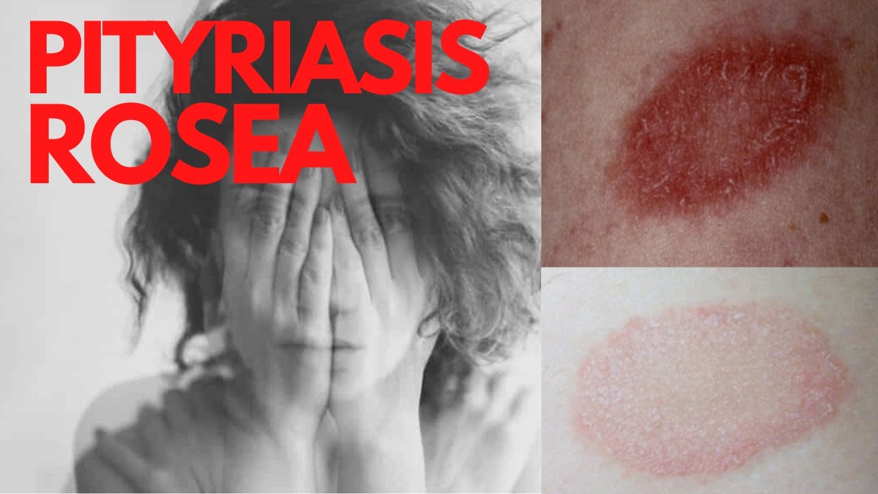 Pityriasis Rosea Answers Of The Common Questions About Pityriasis