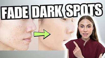 Dark Spots on the Face: What Actually Works (Dermatologist Explains)