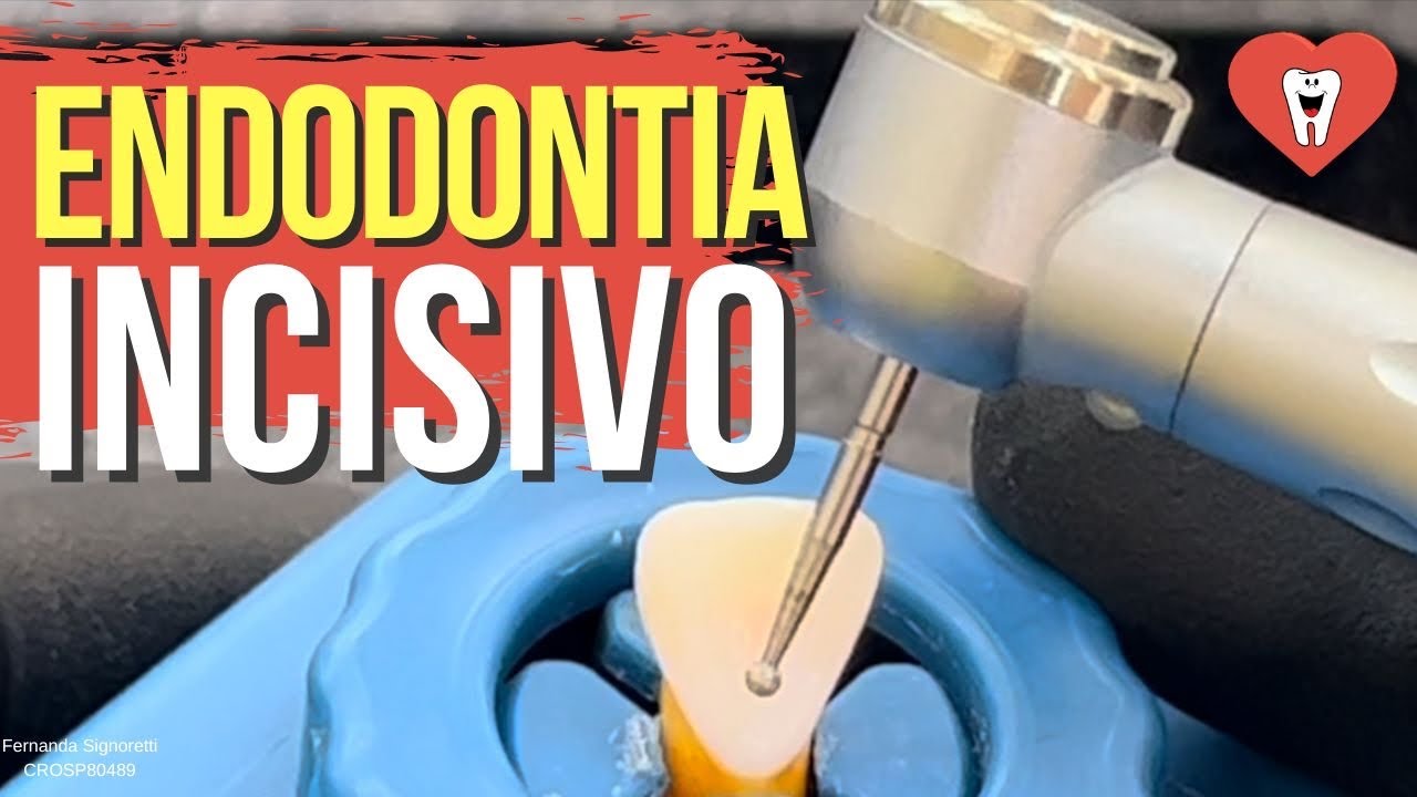 ENDODONTIA SESSÃO ÚNICA INCISIVO SUPERIOR - Endolovers