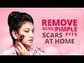 Remove Acne and Pimple Scars/Pits At Home || Ashtrixx