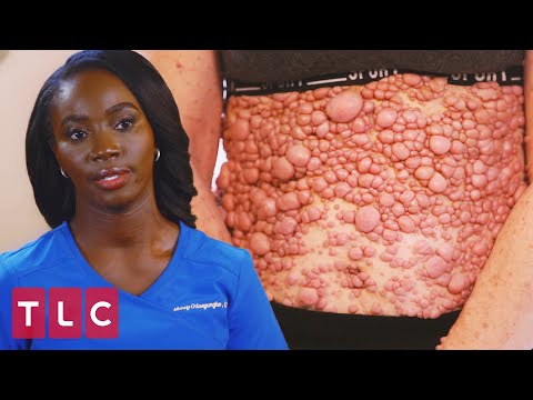 A Severe Case of Neurofibromatosis | Dr. Mercy