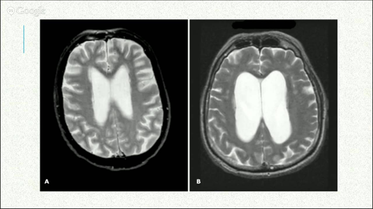 Выражено умеренно гидроцефалия мозга. Нормотензивная гидроцефалия кт. Наружная внутренняя гидроцефалия мрт. Кт головного мозга при гидроцефалии. Нормотензивная гидроцефалия мрт.
