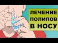 ЛЕЧЕНИЕ ПОЛИПОВ В НОСУ