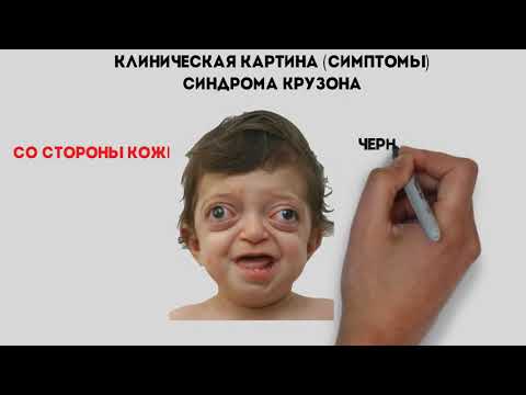 Видео: Синдром на котешки плач - причини, симптоми и лечение