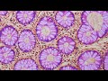 Gut Aging and Cancer: New Insights into Rising Colorectal Risk
