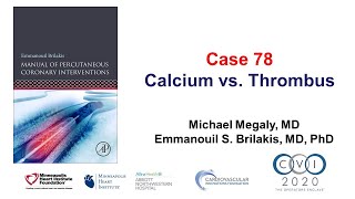 Case 78 Pci Manual - Calcium Vs Thrombus