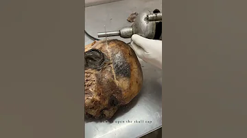 Cadaveric Dissection Of Skull For Teaching Anatomy 