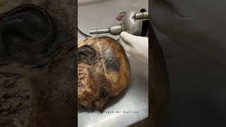 Cadaveric Dissection of skull : Anatomy