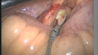 STUMP APPENDICITIS 1