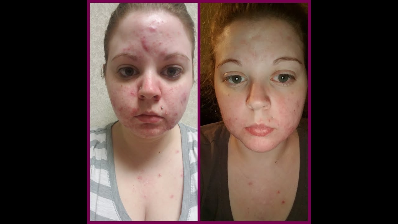 Life after accutane returns