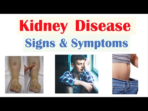 Kidney (Renal) Disease Signs & Symptoms (ex. Peripheral Edema, Fatigue, Itchiness)