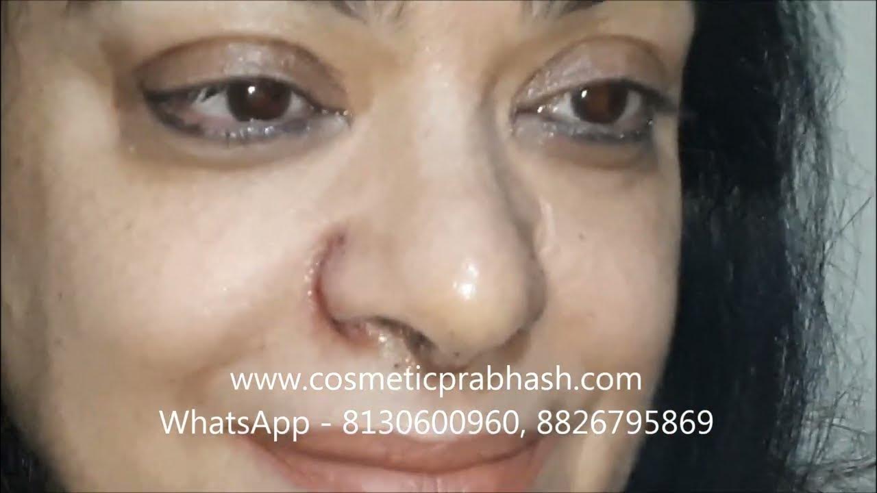 Alarplasty Before After Cost Result Delhi NCR India Dr Prabhash Big