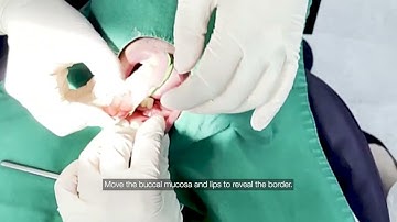 How to scan a patient using Resin Partial Denture (RPD)