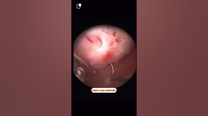 Mioma submucoso, infertilidade e cirurgia #fertilizaçãoinvitro #fiv #fertilizaçãoassistida #icsi