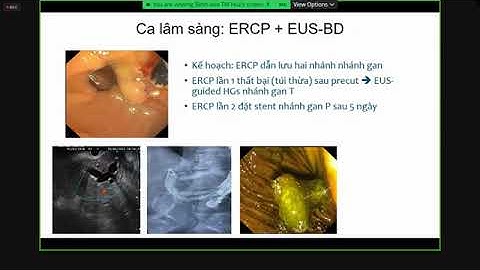Hẹp rốn gan: Nội soi chẩn đoán và can thiệp điều trị