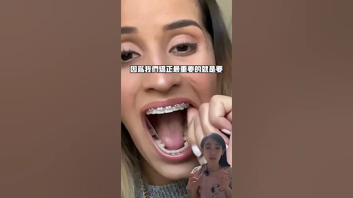 她的矯正醫師會很生氣😳#牙齒矯正#戴牙套 - 天天要聞