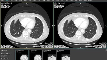 Realize CT Lung Nodule Detection Demo