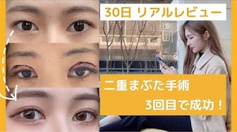 韓国二重整形 Youtube