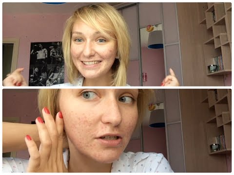 Video: Pimple Sormella: Tärkeimmät Syyt Ja Hoidot