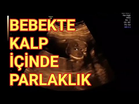 Ultrasonda bebekte kalp içinde beyaz leke, parlaklık (ekojen intrakardiyak odak) nasıl görünür?