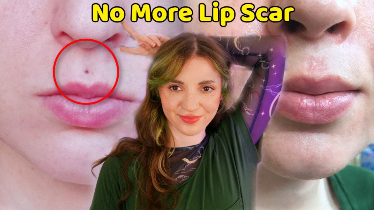 My Lip Piercing Scar Removal | Cost, Before & After - YouTube