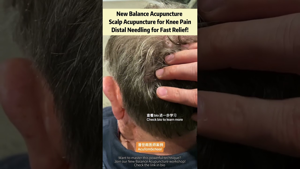 New Balance Acupuncture | Scalp Acupuncture for Knee Pain—Distal Needling for Fast Relief!