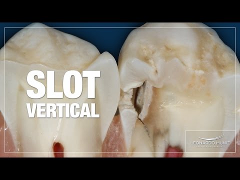 Vídeo: Cavidade Interproximal: Uma Cavidade Entre Os Dentes