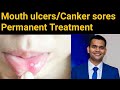 Mouth ulcers / Canker sores permanent treatment | How Do You Get Rid of a Canker Sore