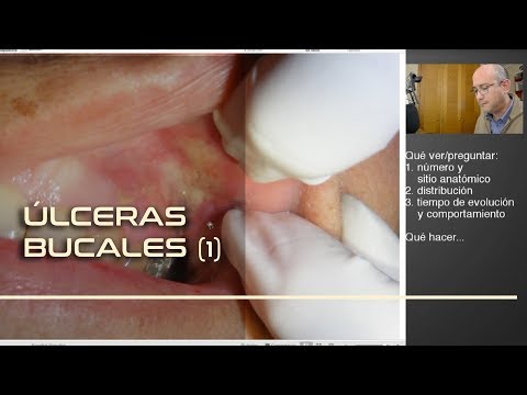 Patología Oral / Emisión en directo nº7: Úlceras bucales dolorosas.