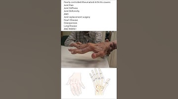 Made You Look: Rheumatoid Arthritis Can be Treated (with Pics)